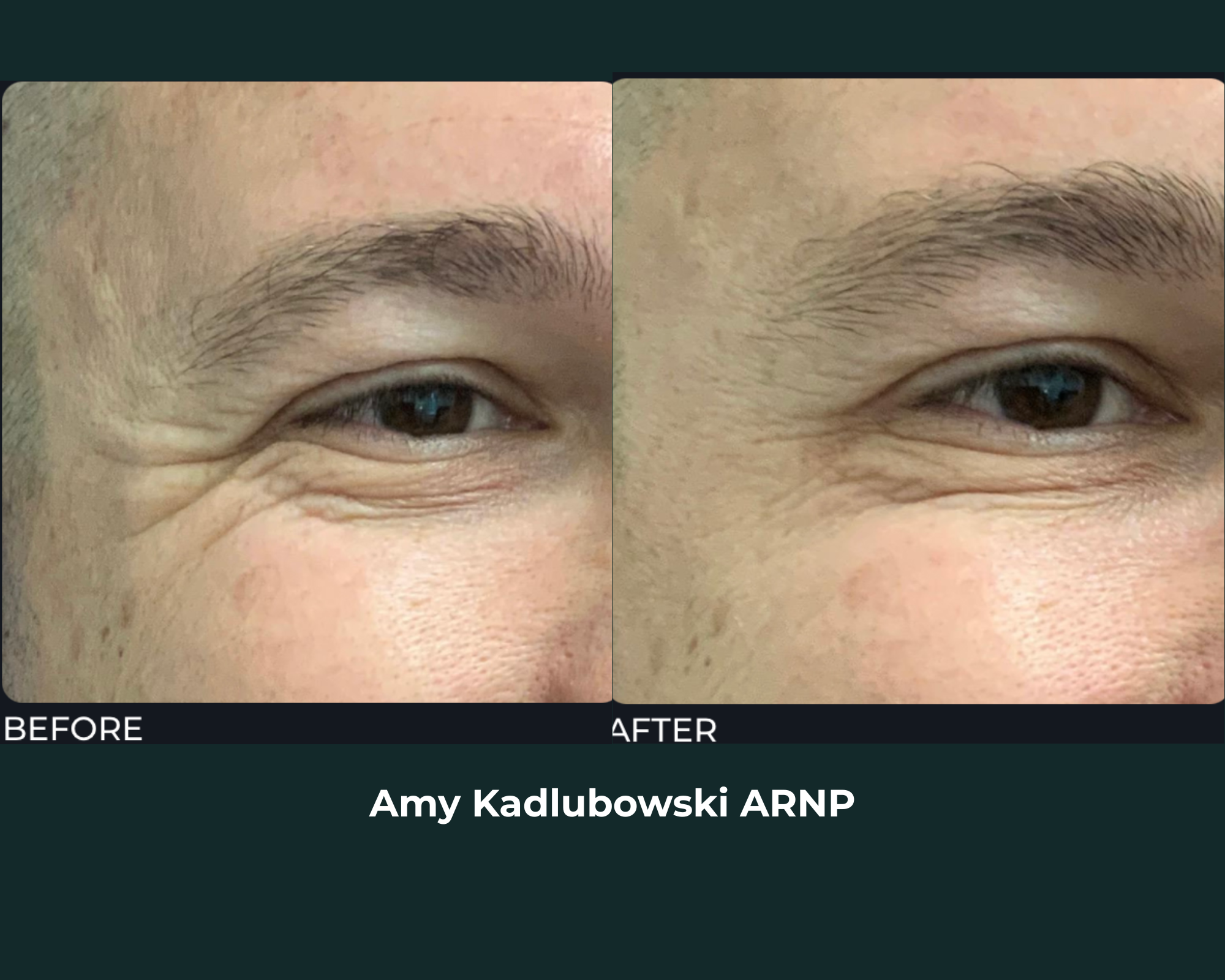 Botox before and after - Crow's feet treatment by Amy Kadlubowski ARNP