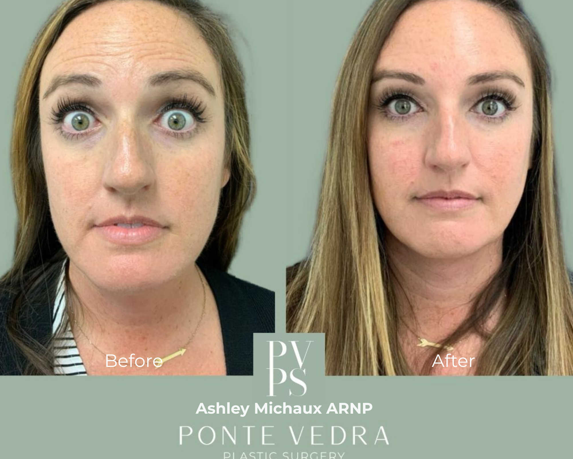 Botox before and after - Forehead treatment by Ashley Michaux ARNP