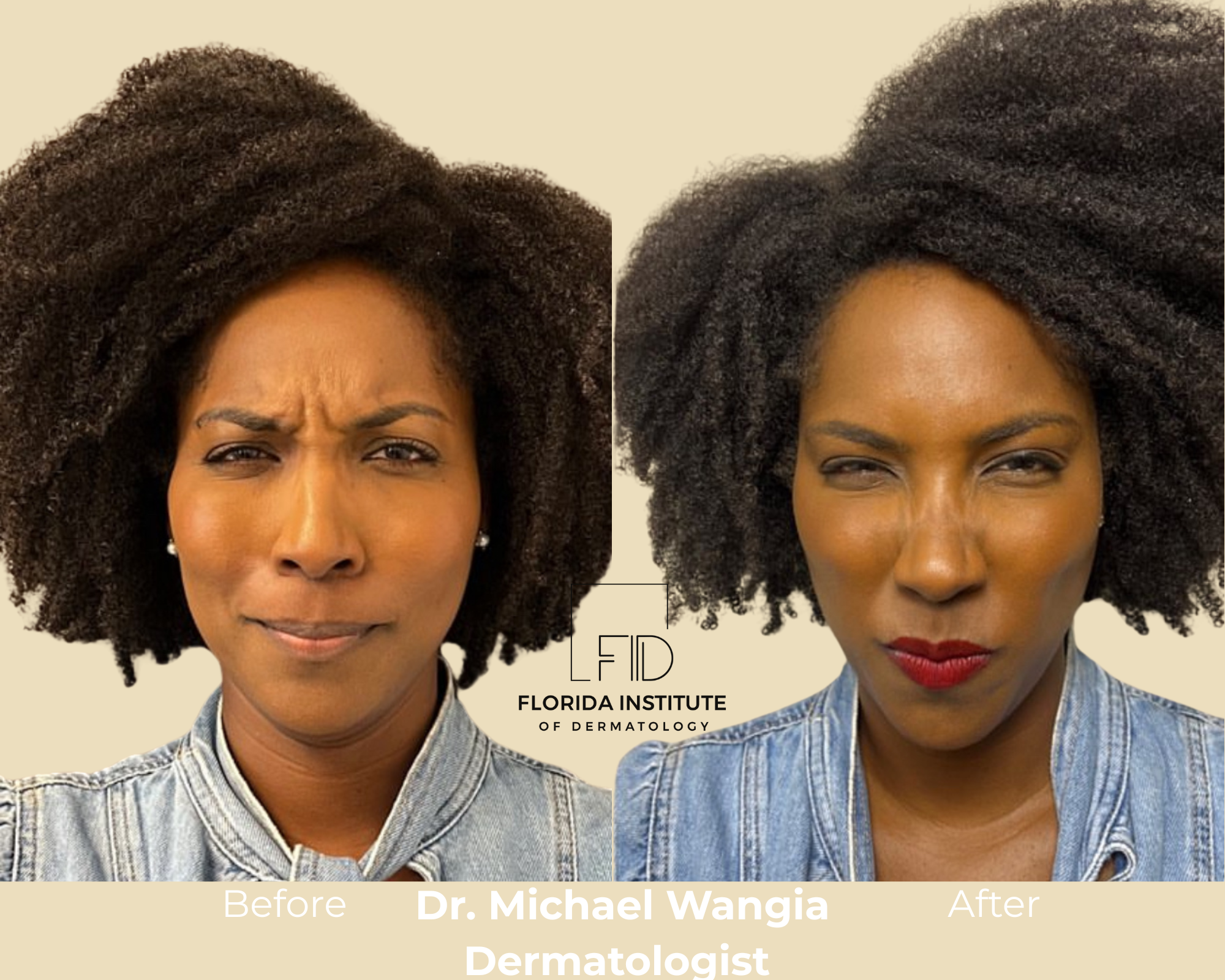 Botox before and after - Forehead treatment by Dr. Michael Wangla